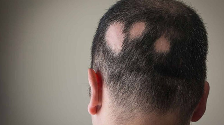 First FDA-Approved Drug for Alopecia areata - Aziz Aksöz