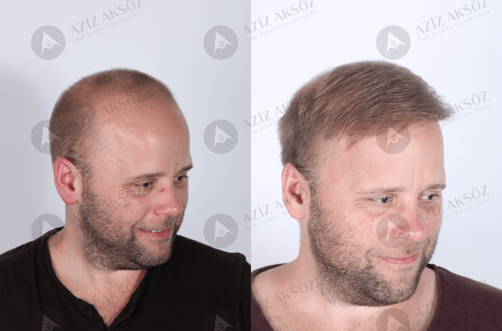 Travel After Hair Transplant - Aziz Aksöz