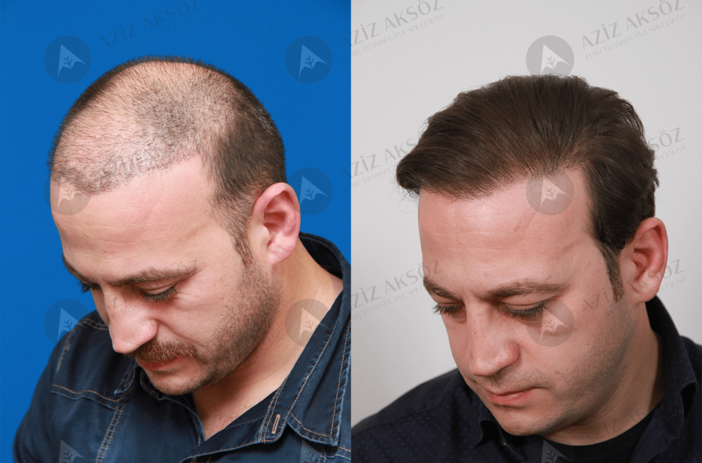 Essential Tips For Hair Care After A Hair Transplant