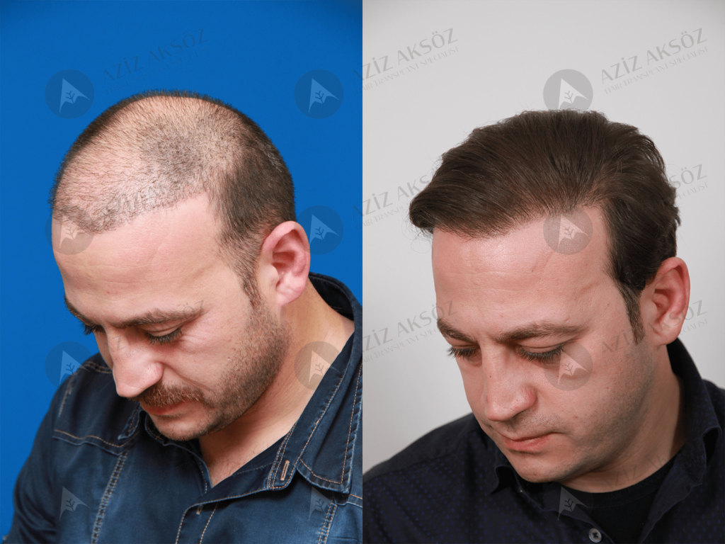 Fue Hair Transplant - Hair Specialist - Vagus Cosmetics | LinkedIn