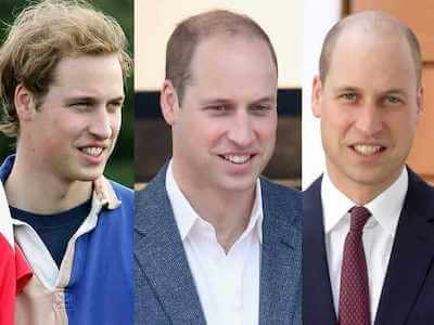 Why Doesn't Prince William Get A Hair Transplant? - Aziz Aksöz