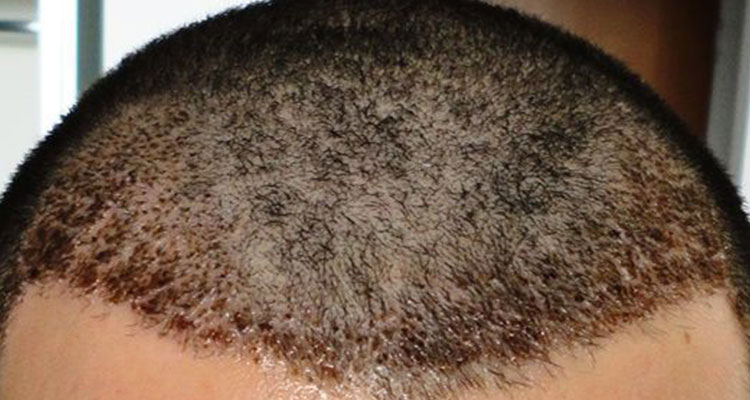 The Role Of Scalp Health In Optimal Hair Growth - Aziz Aksöz