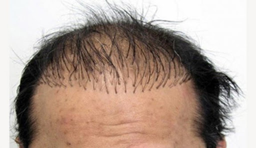 Is The Hair Transplant For You: Exploring The Pros and Cons